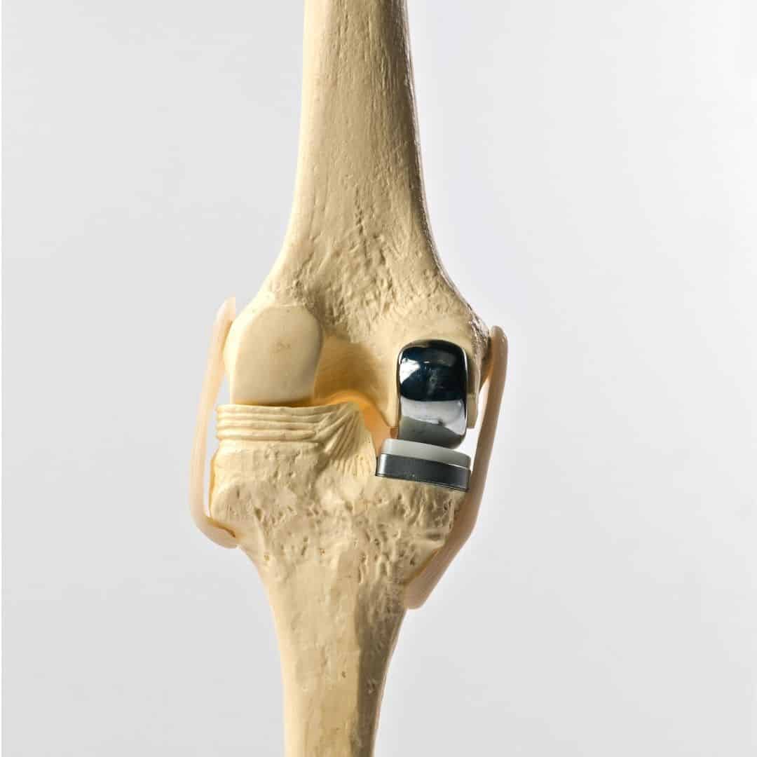 Partial Knee Replacement Surgery
