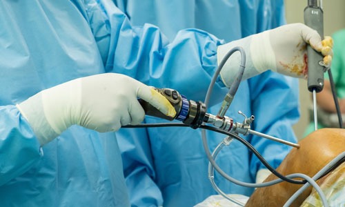 Shoulder Arthroscopy
